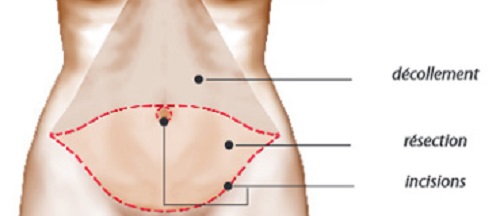 abdominoplastie en tunisie