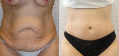 abdominoplastie tunisie avant apres