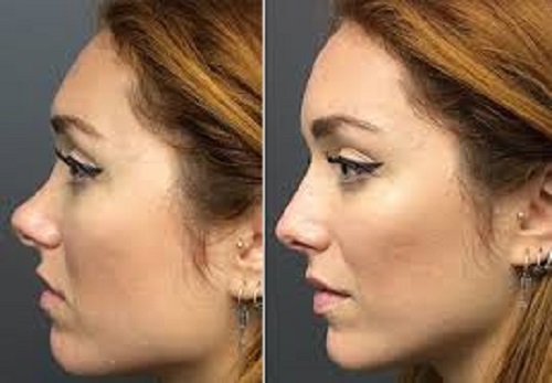 rhinoplastie tunisie avant apres