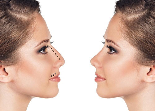 rhinoplastie tunisie